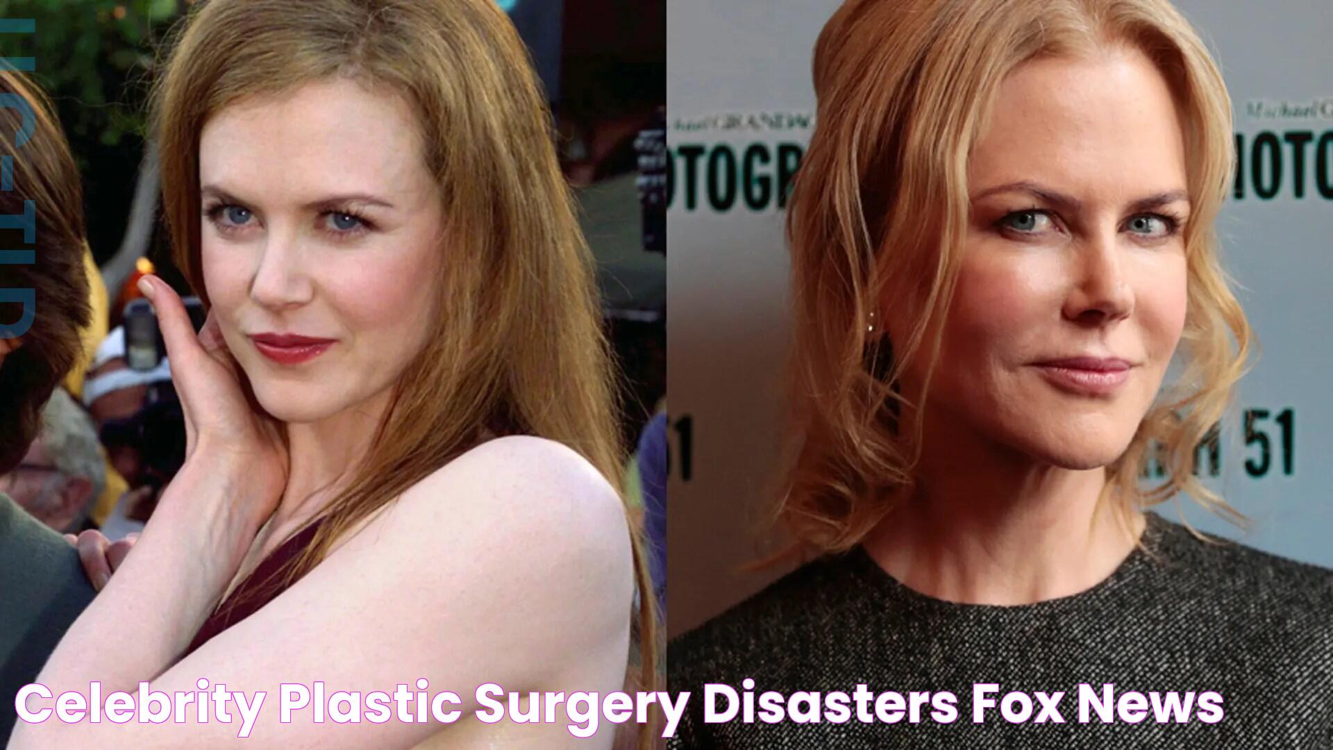 Celebrity plastic surgery disasters Fox News