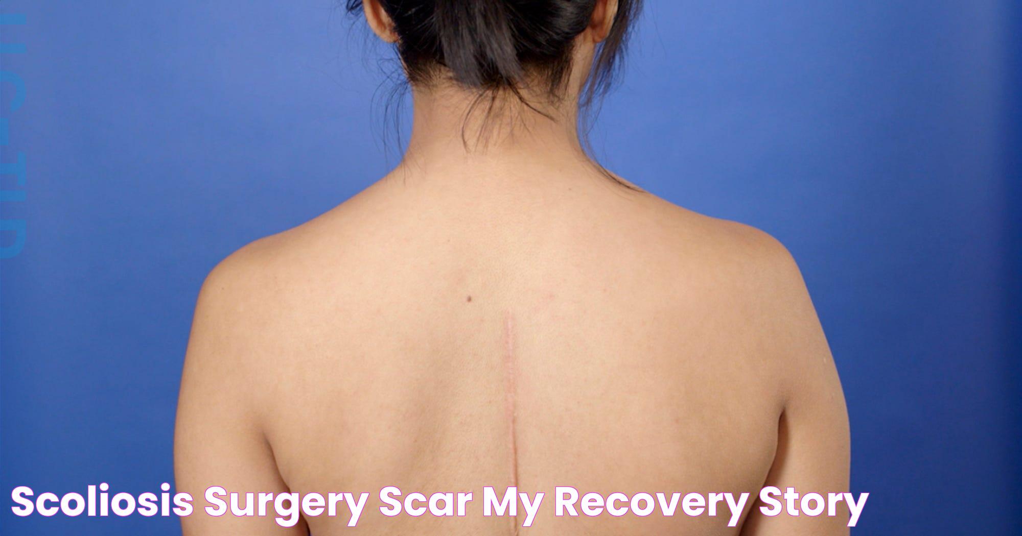 Scoliosis Surgery Scar My Recovery Story