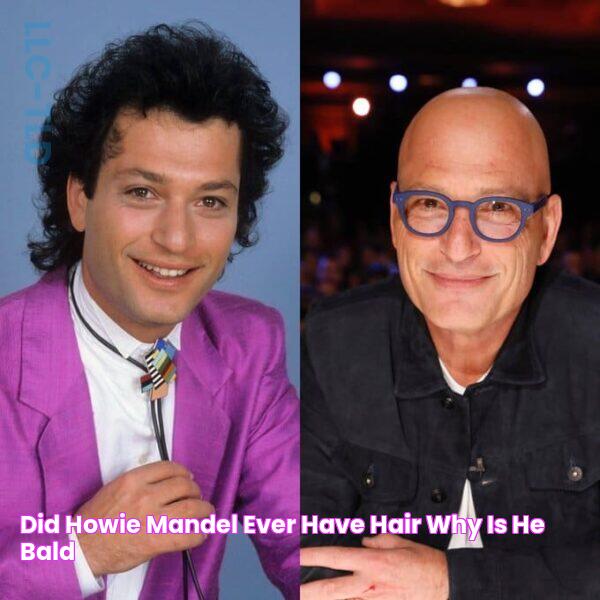 Did Howie Mandel Ever Have Hair? Why is He Bald?