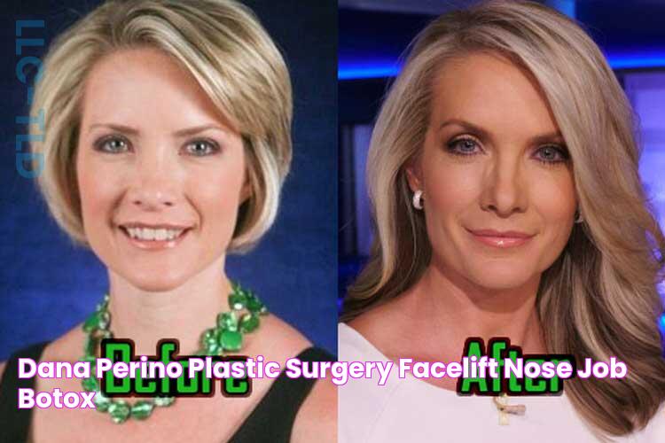 Dana Perino Plastic Surgery Facelift, Nose Job, Botox