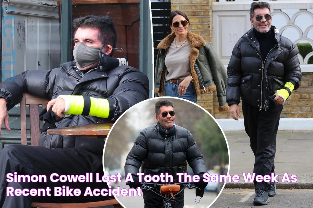 Simon Cowell lost a tooth the same week as recent bike accident