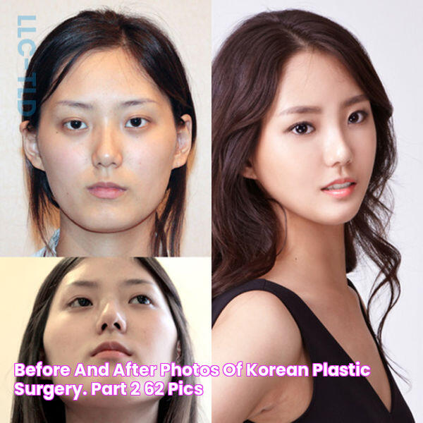 Before and After Photos of Korean Plastic Surgery. Part 2 (62 PICS