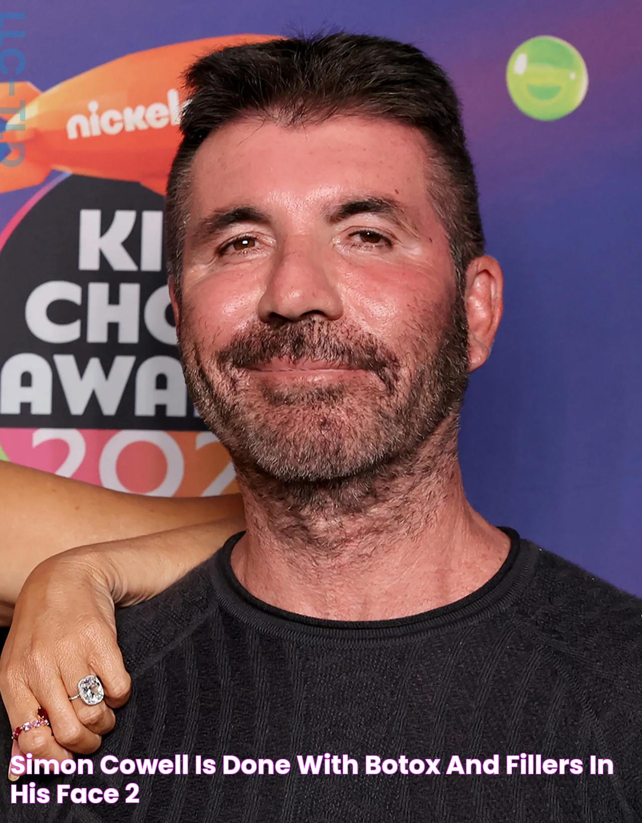 Simon Cowell is done with Botox and fillers in his face