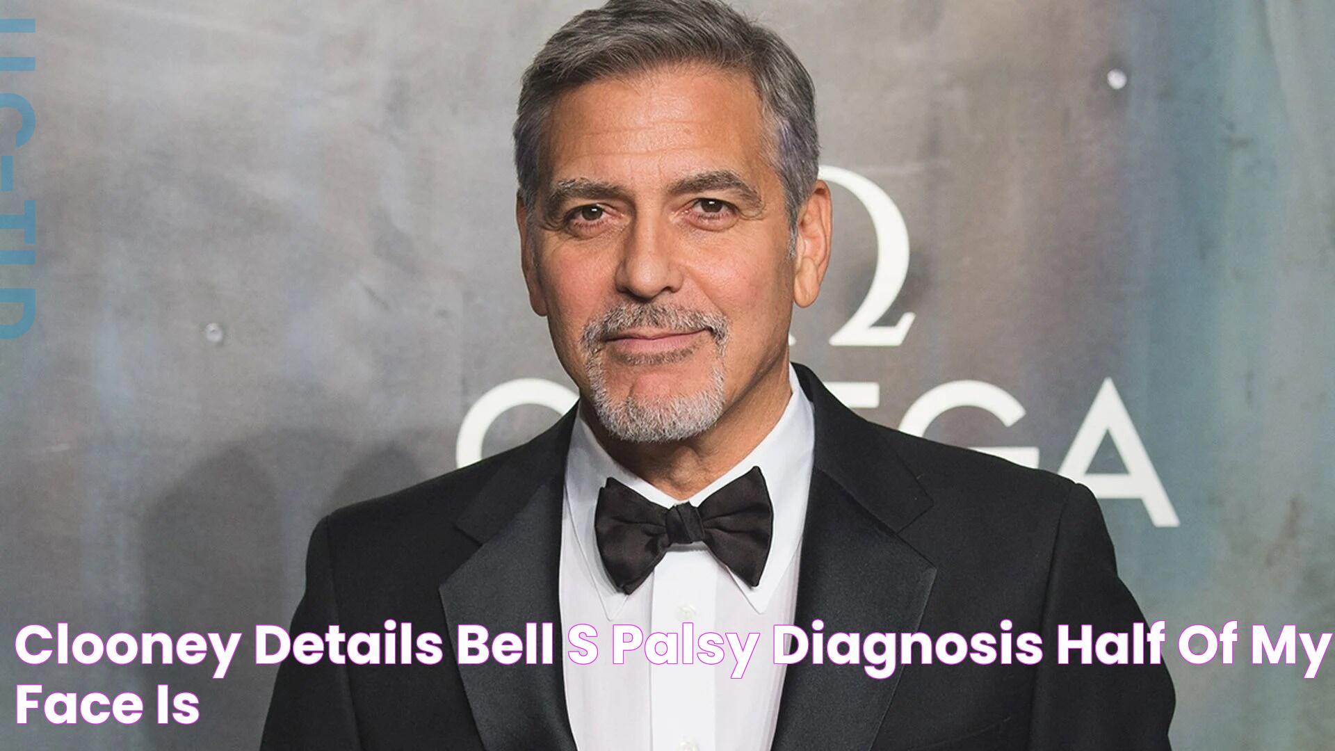 Clooney details Bell's palsy diagnosis 'Half of my face is