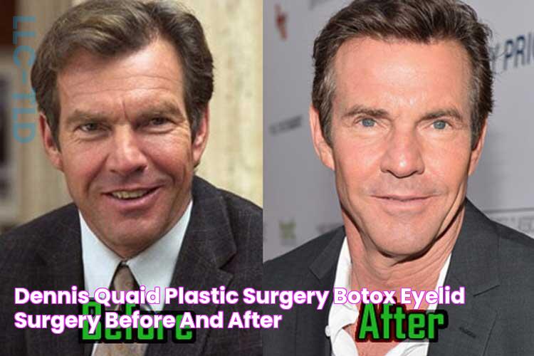 Dennis Quaid Plastic Surgery Botox, Eyelid Surgery, Before and After