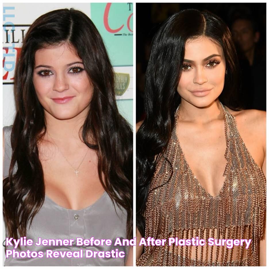 Kylie Jenner Before and After Plastic Surgery Photos Reveal Drastic