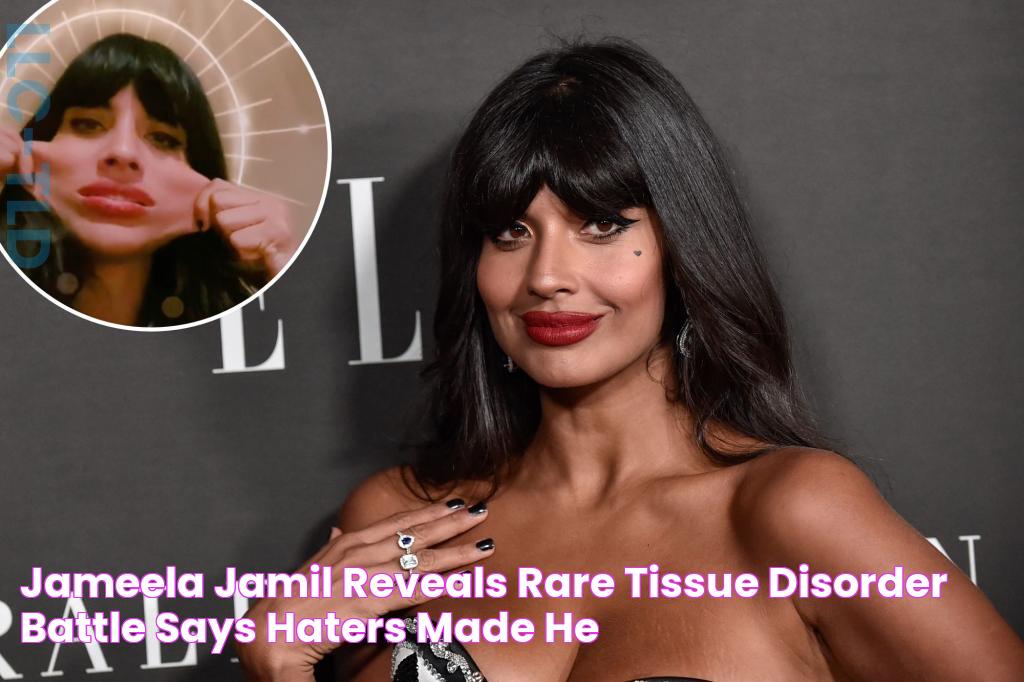 Jameela Jamil reveals rare tissue disorder battle, says haters made he