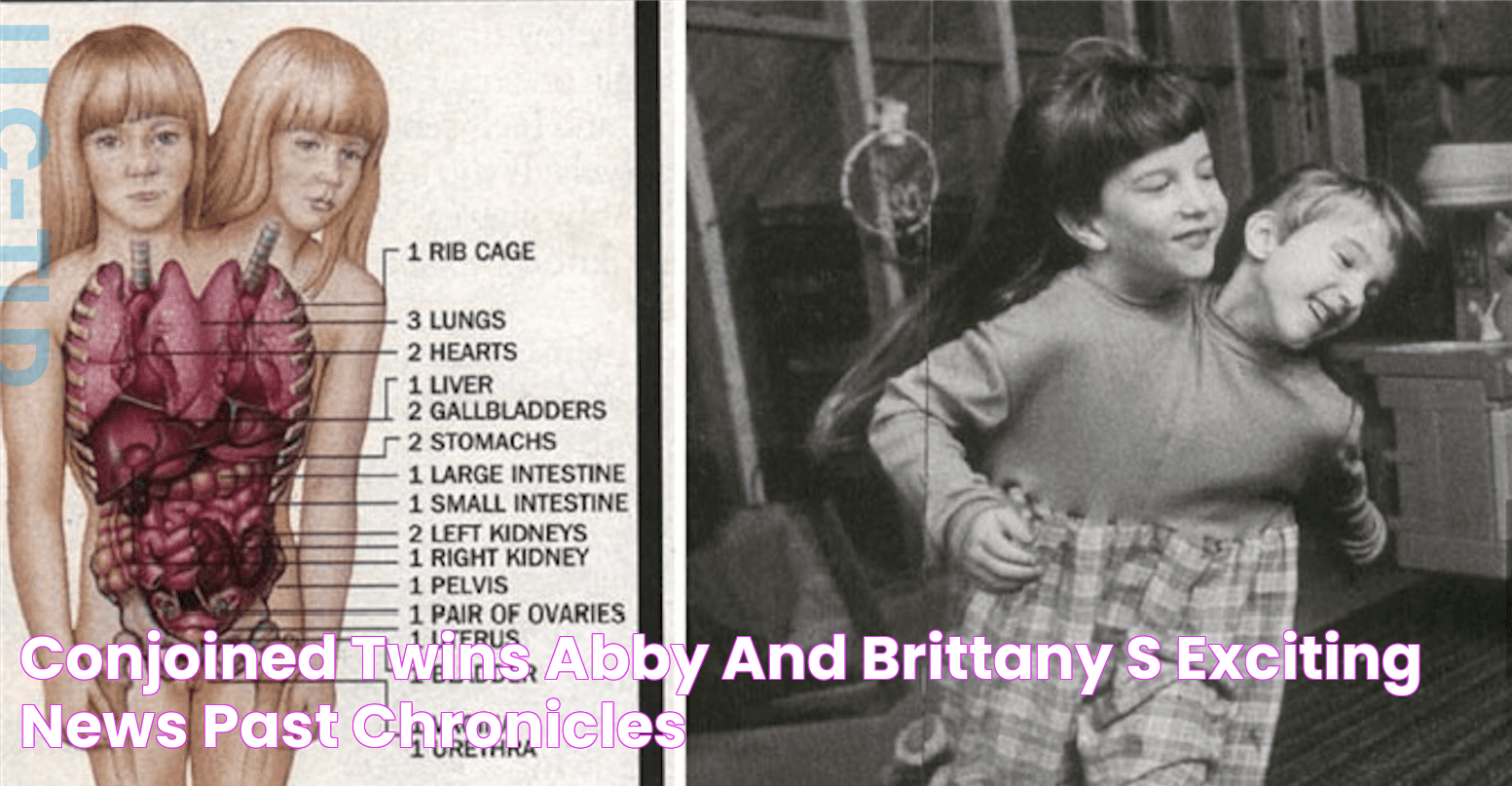 Conjoined Twins Abby and Brittany's Exciting News! Past Chronicles