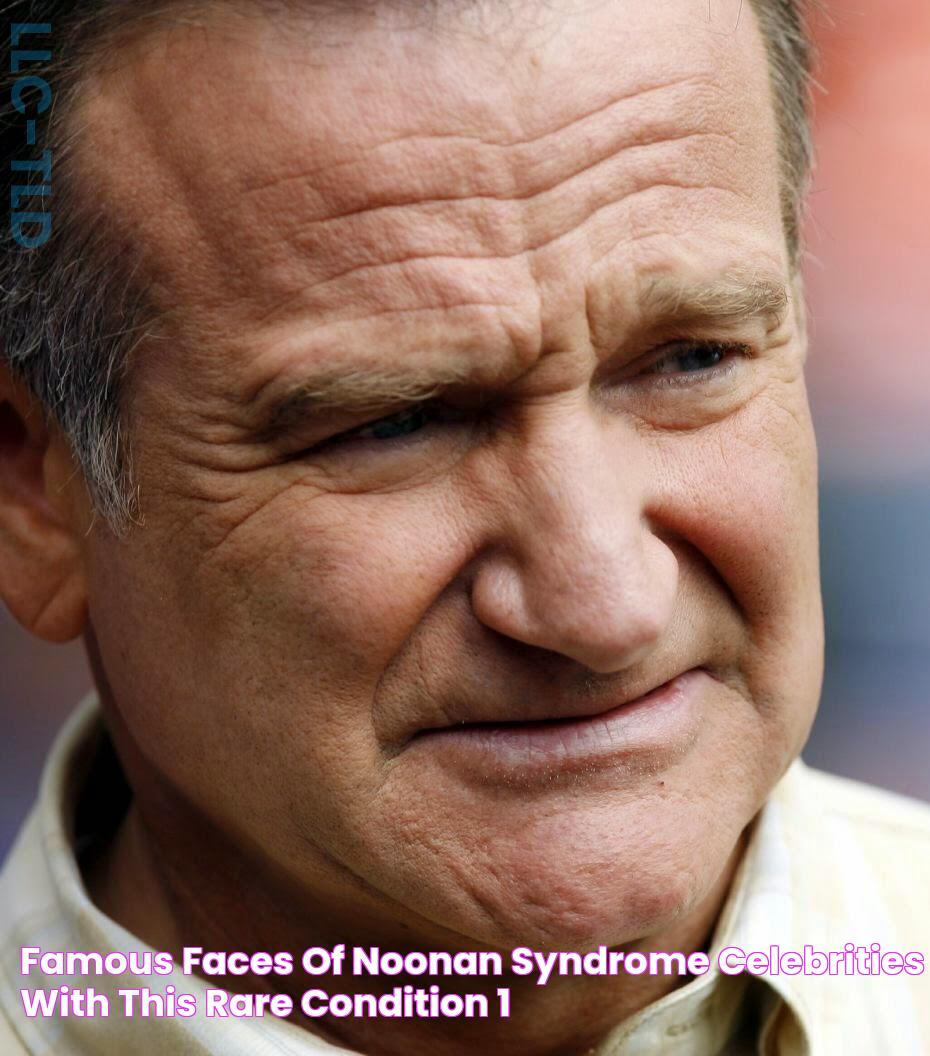 Famous Faces Of Noonan Syndrome Celebrities With This Rare Condition