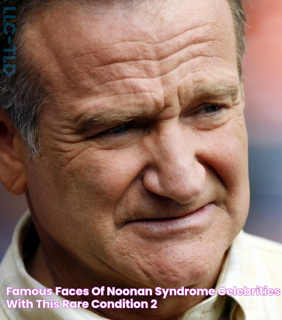 Famous Faces Of Noonan Syndrome Celebrities With This Rare Condition