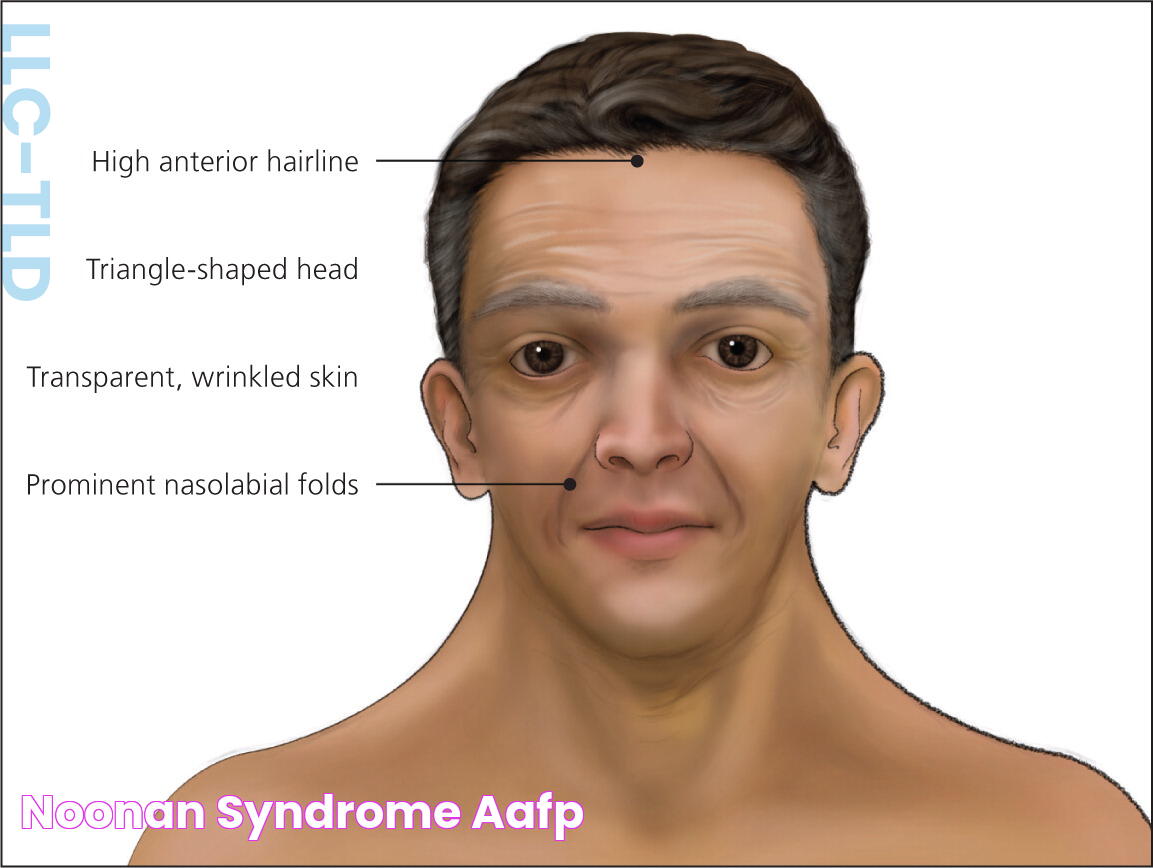 Noonan Syndrome AAFP